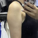 한이팻 | 지방추출주사 팔뚝 지팻주사 내돈내산 후기 (효과, 부작용, 흉터)