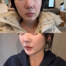 티엠바이오 | 강남피부과 내성적은 티엠버스보톡스로 브이라인 만들기