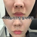 세븐일레븐 수원파장중앙점 | 청담피부과 티타늄리프팅 시술 후기 팔자주름 개선 효과