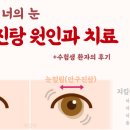 은진탕 | 증상, 치료법 완벽정리 (Feat. 안구진탕 수험생 환자의 후기) &#34;흔들리는 눈동자의 모든 것 살펴보기&#34;