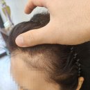현암로89번길 | 1회 시술 만으로도 달라지는 변화를 경험한 용인헤어라인 심닷스칼프 후기