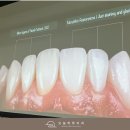 문정동치과 성공적인 앞니 라미네이트를 위한 조건 (백장현 원장님 세미나 후기)