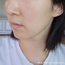 11305-15-600-1 | 성수역피부과 볼뉴머600샷 볼뉴머잘하는곳 볼뉴머후기 추천