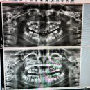 늘푸른미소치과의원 | 초등 1차교정 후 방학검진 온천장 교정전문치과 늘푸른미소치과