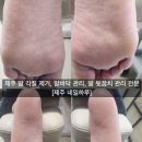 문제성 손발톱 전문관리 케어톱톱