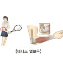 Re:테니스 엘보 치료법 이미지