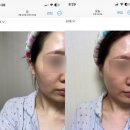 대한메디케어 | 라누벨뽀 메디케어폴라필 내돈내산 강추 후기