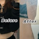 대전 멍택시 | [다이어트] 대전 러브핸들(복부) 무한람스 당일~ 1주차 솔직 후기! (상담, 탈장, 멍, 붓기, 통증, 일상...