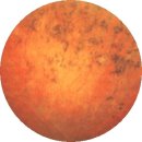 망막색소변성증(Retinitis Pigmentosa) 눈 질환이란? 이미지