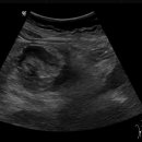 colon ca with intusscepsion shape 이미지