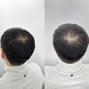 헤드샷스칼프SMP부산