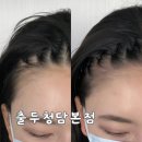 출두대구 | 강남두피문신 출두smp 청담본점 1회차 후기