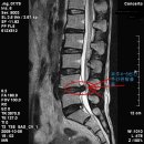 (허리디스크 치료사례 -19) 요추4-5번간 추간판 탈출증 F/50세 *** 님 치료전-후 MRI비교- 이미지