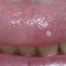 간이식후 혀에 염증이 생기는데왜그런가요? 이미지