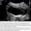 Duplex Kidney 이미지