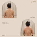 명(明) - 군포시 | 하남 웨딩케어 등관리 어깨라인 비대칭 개선 명윤곽 후기