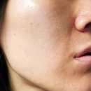 스팟 | 디크솔 큐라스팟 후기 | 비립 쥐젖 요철 케어 파우더 솔직 사용기 (+약국 품절대란)