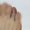 백석정형외과의원 | 유리병맞은 발가락 / 발가락부상 , 발가락 X-ray 가격 , 발가락 CT 가격 / 현대해상 실비보험 청구...