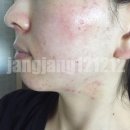 수한의원 | 피부과 여드름 치료 가격 한의원 후기 보고 다녀온 이유