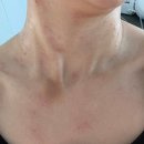 대전 편평사마귀 쥐젖 제거 내돈내산 후기