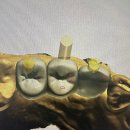 남포치과의원 | 남포 임플란트치과, 잇몸이 너무 약해도 수술 되나요?