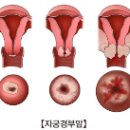 송철용의원 | [여성질환] 자궁경부암ㅣ생식기종양ㅣCervical cancerㅣ여자가 주의해야 하는 악성 종양ㅣ자궁경부암...