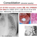 흉부 X선 (Chest X-ray) 사진 판독 이미지