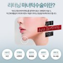 리터닝성형외과의원 | 처진 턱끝 해결! 리터닝 마녀턱수술로 되찾는 또렷한 윤곽라인 ㅣ리터닝성형외과