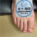 남구-145 | 부산 남구 푸스케어 부산광안리W스퀘어점 발톱 무좀 케어 후기