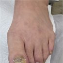 GS25진주장대점 | 진주 하대동 발톱무좀 부서지고 두꺼워진 발톱 후네일&amp;베어진주장대점에서 벗어났어요
