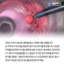 우습게 보다간 큰일나는 항문암 예방법ㅤ 이미지