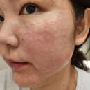 더샤인한스의원 | 부평 동암역 피부과 더샤인의원 LDM 리쥬란 2CC 내돈내산 후기