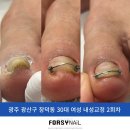 이마트에브리데이동림동점 | [광주 동림동 네일샵] 신발 신을때마다 아픈 내성발톱더이상 고민하지 말자!!