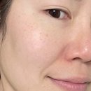 송이이모네&언니들꽃차 | [신대방] 구로디지털단지역 &#39;송예린뷰티월드&#39;에서 기미 잡티제거 레이저토닝 6회차 후기