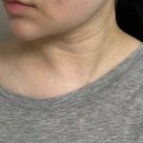 센텀성형외과의원 | 부산 센텀 성형외과 목주름필러 대만족 리얼 후기