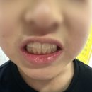 파주운정 어린이 교정치과, 1년10개월 만에 아들 교정기 뺀 날