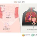 절개 또는 배농술, 배액술 [기타 수술의 정의에 해당하지 않는 시술(예시)] 이미지