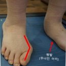하나로구두병원 | 무지외반증 치료 후기, 수술과 비수술 사이에서 내린 결정