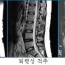 대한바른자세연구회에서 하는 일 - 허리디스크 이미지