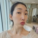 신사동-20 | 신사동 성형외과 브이맥스 리프팅 효과 변화와 적은 통증 탄력주름 개선 찐 후기