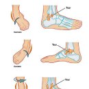 발목 염좌(Ankle Sprains) Ⅰ 이미지