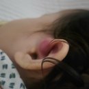 우린동물병원 | 21개월 아기 이루공 제거 수술 후기 (인천 길병원)