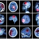 ​의식 상태를 단번에 파악하다! 글래스고 혼수 척도 이미지