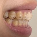 더바른이치과교정과치과의원 | [내돈내산] 30대 인비절라인 교정 중! 벌써 1년이 된다고? <서울바른치과교정치과의원 안양>