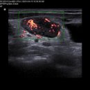 infective lymphadenopathy d/d)kikuchi disease 이미지