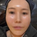 샤인피부미용 | 피부관리 끝판왕 여드름 흉터 없애는법 M샤인주사EX 강남역피부과