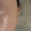 상동 | [경기/상동] 상동 문제성피부관리 뷰티포톤피아 부천상동점 후기