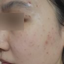 강남가드비뇨기과의원 | [강남/선릉_힐 비뇨기과] 얼굴 전체 잡티 제거 후기