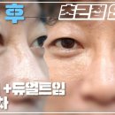 [4k] 중년남성의 변신! 눈밑지 + 듀얼트임(뒷트임 밑트임) 3개월차 ! / 빠르게 일상 생활이 가능한 수술?! 이미지
