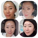 인생바껴 인셀덤 네이버블로그